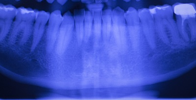 aurora composite fillings