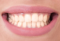 Teeth Whitening Aurora