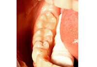 Teeth Extraction Aurora