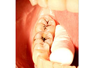 Teeth Extraction Aurora