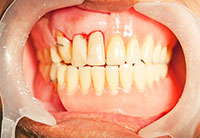 Dental Crown Aurora