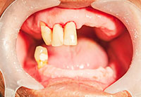 Dental Implants Aurora