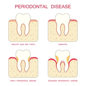 periodontal therapy aurora