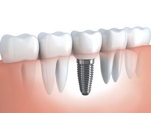dental implants aurora